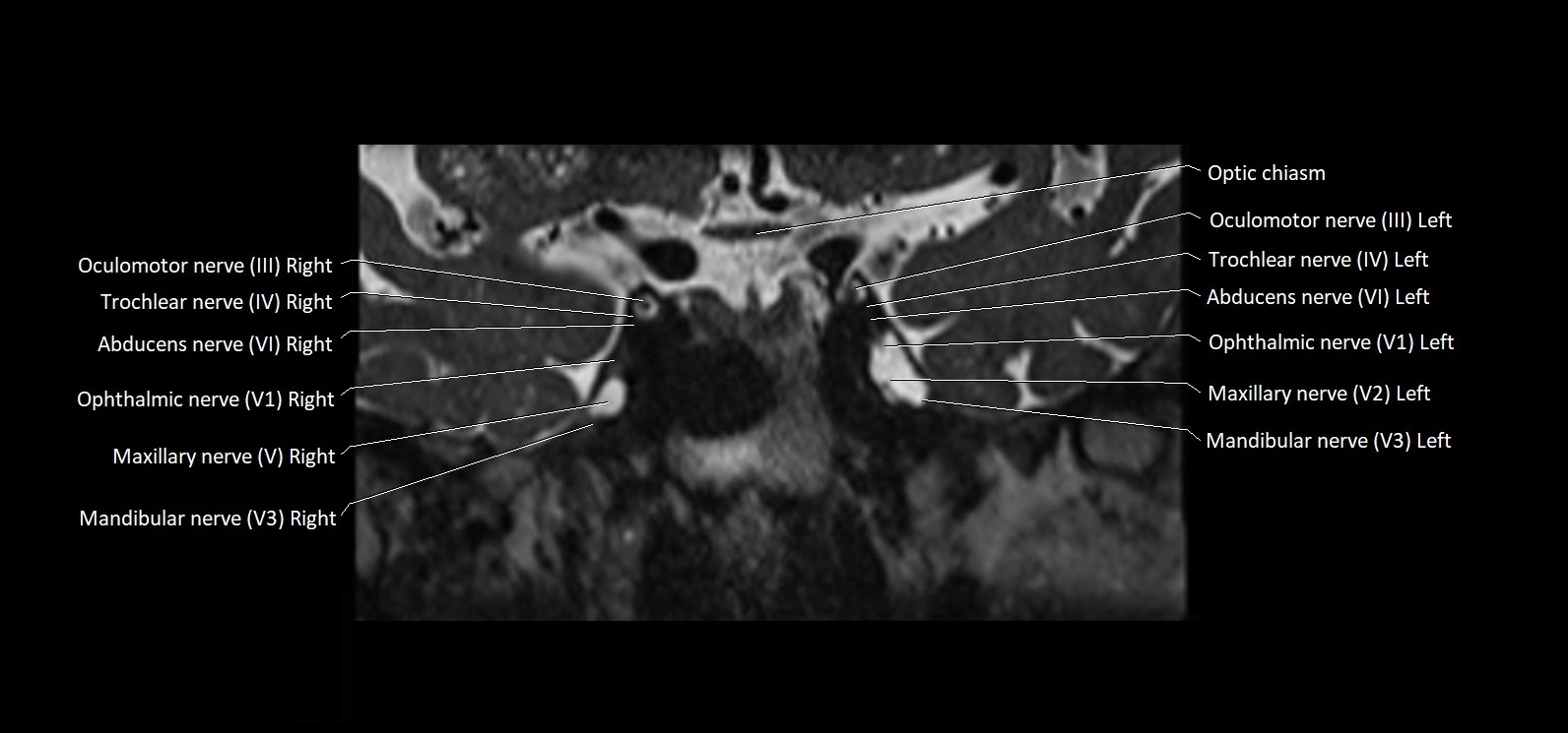 Cranial nerve cross sectional anatomy coronal 3T MRI image 28.webp